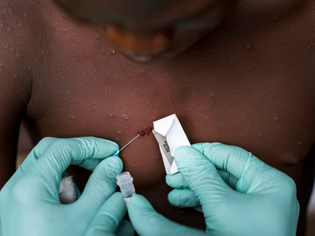ΕΜΑ: «Πράσινο φως» σε νέα τεχνική για τη χορήγηση εμβολίου κατά της ευλογιάς των πιθήκων